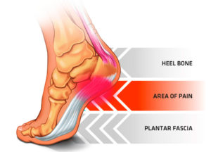 How to use CBD Oil for Plantar Fasciitis? Benefits of using cannabidiol