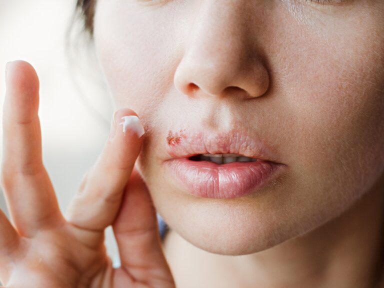 CBD and Herpes How to Use it For Treatment?