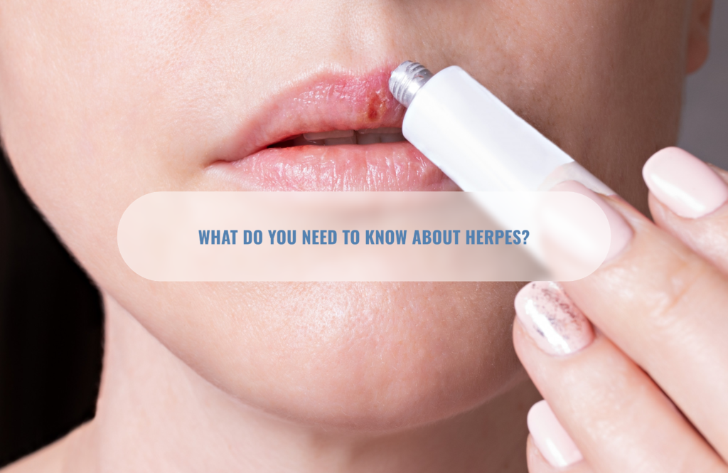 What do you need to know about herpes?