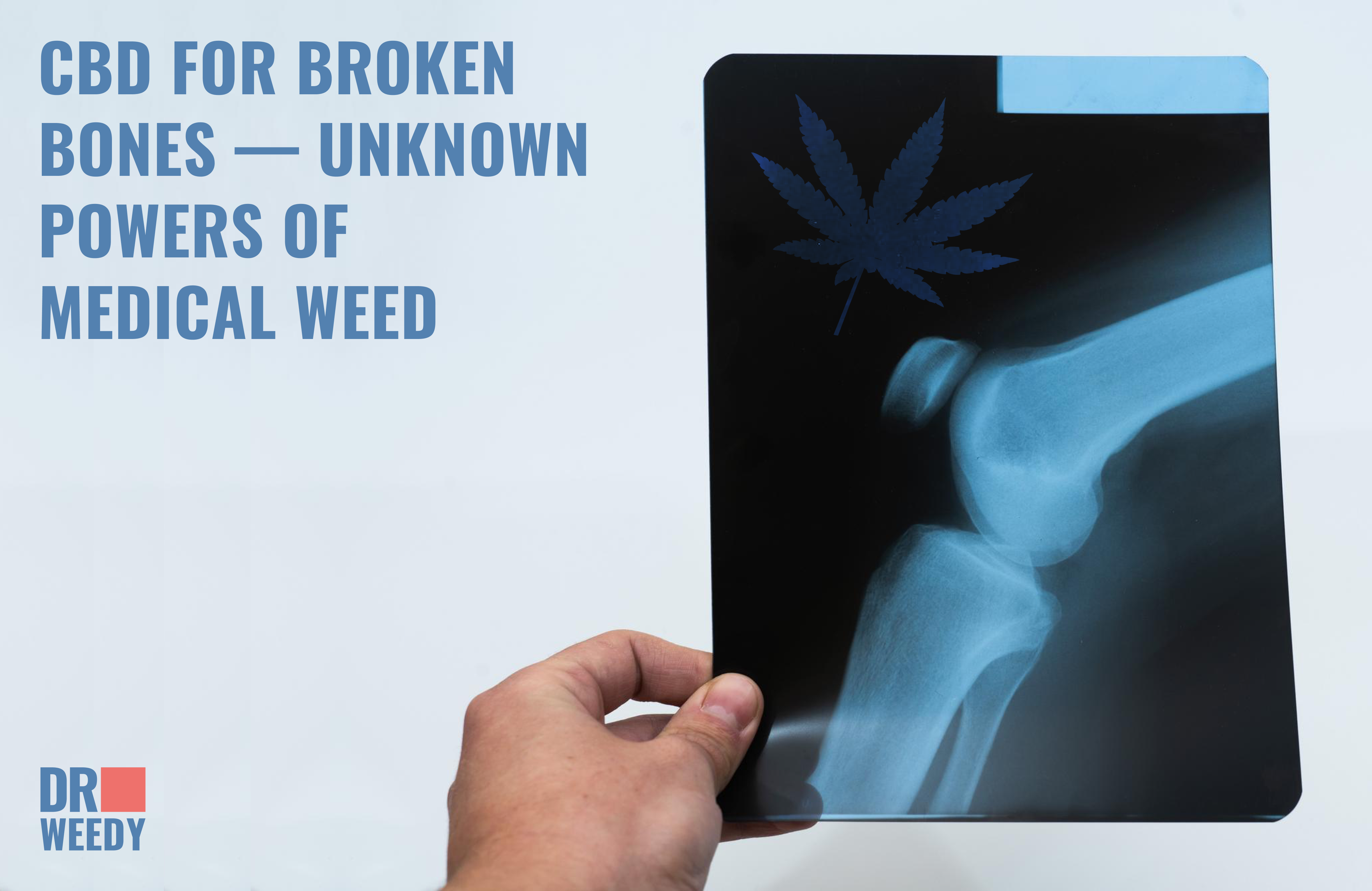 CBD for Broken Bones — Unknown Powers of Medical Weed