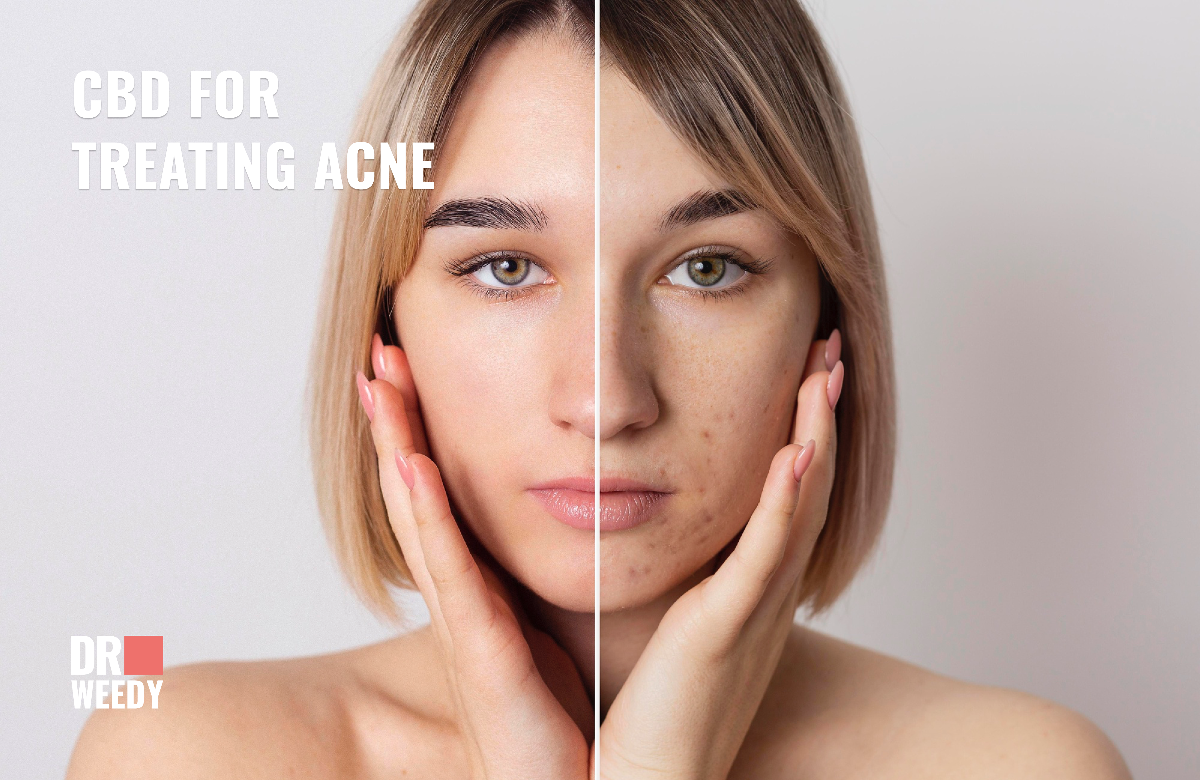CBD for Treating Acne