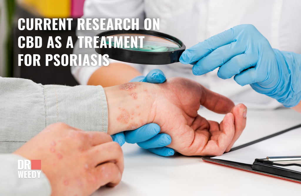 Current research on CBD as a treatment for psoriasis 